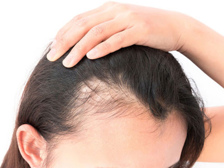 Androgenetic Alopecia Related Information And Treatment You Should Know