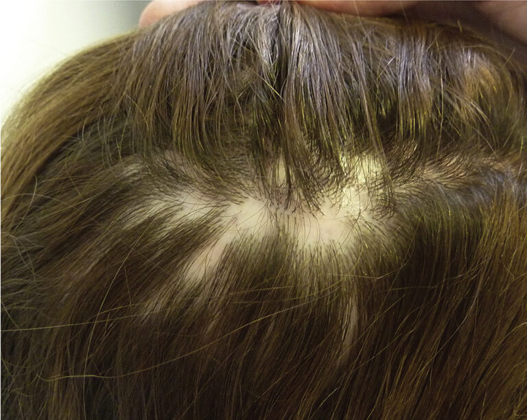 Cicatricial Alopecia Related Information And Treatment You Should Know